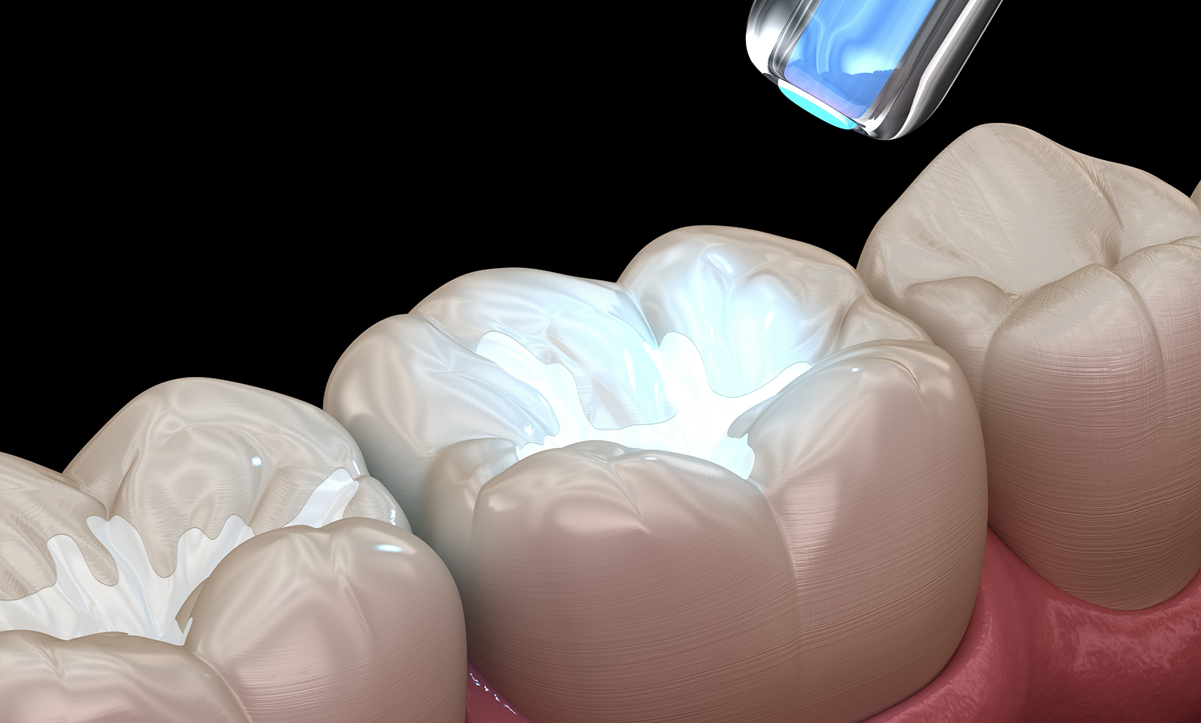 Illustration of an ultraviolet light being applied to a filling on a tooth